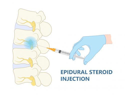 How does an Epidural Steroid Injection Work for Pain Management?
