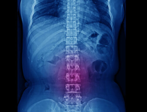 Introducing Minimally Invasive Lumbar Decompression (M.I.L.D.)